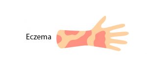 Eczema