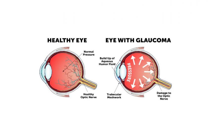  CBD For Glaucoma