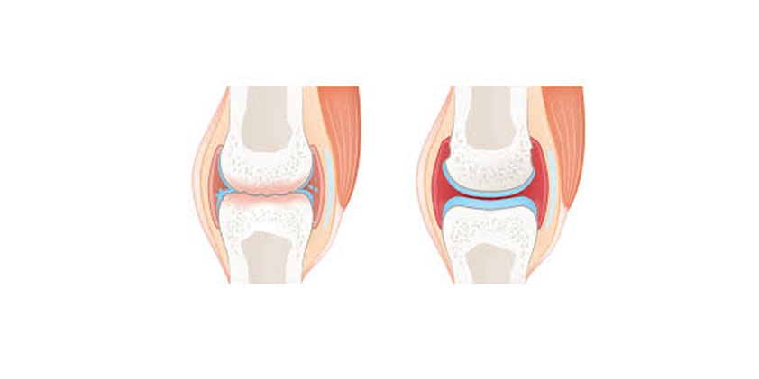  CBD as a Treatment for Osteoarthritis