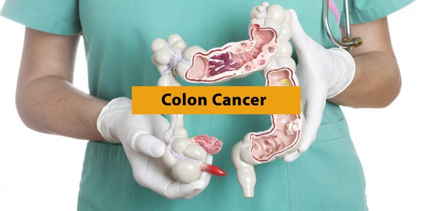  How CBD Can Help in the Fight Against Colon Cancer