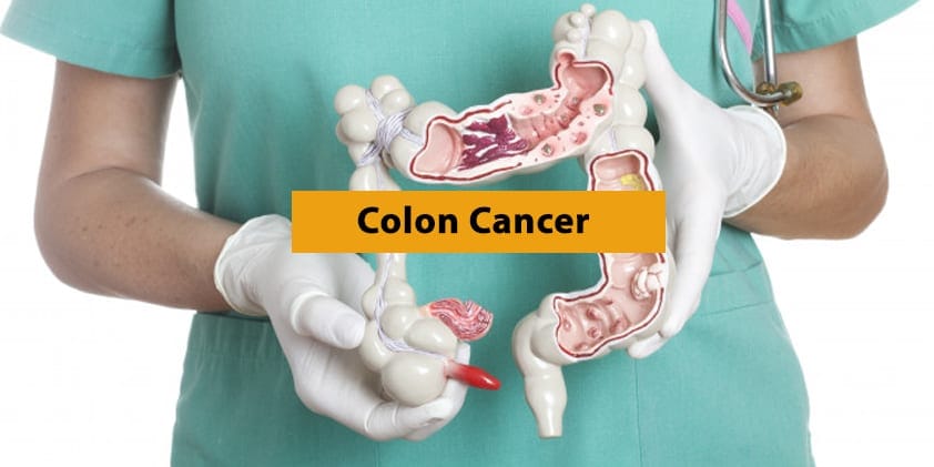 How CBD Can Help in the Fight Against Colon Cancer (lead image)