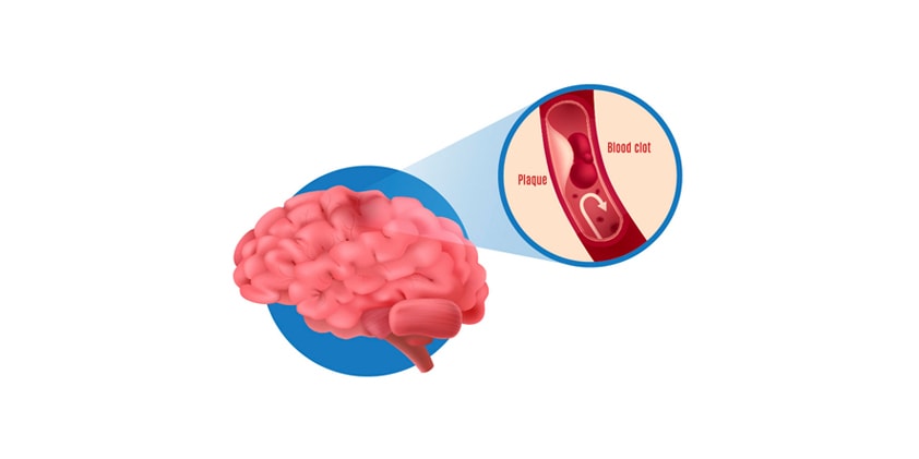 CBD Oil for Vascular Dementia: What the Research Says (lead image)