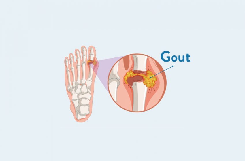  How CBD Can Help Work Out Your Gout