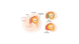graves' ophthalmopathy