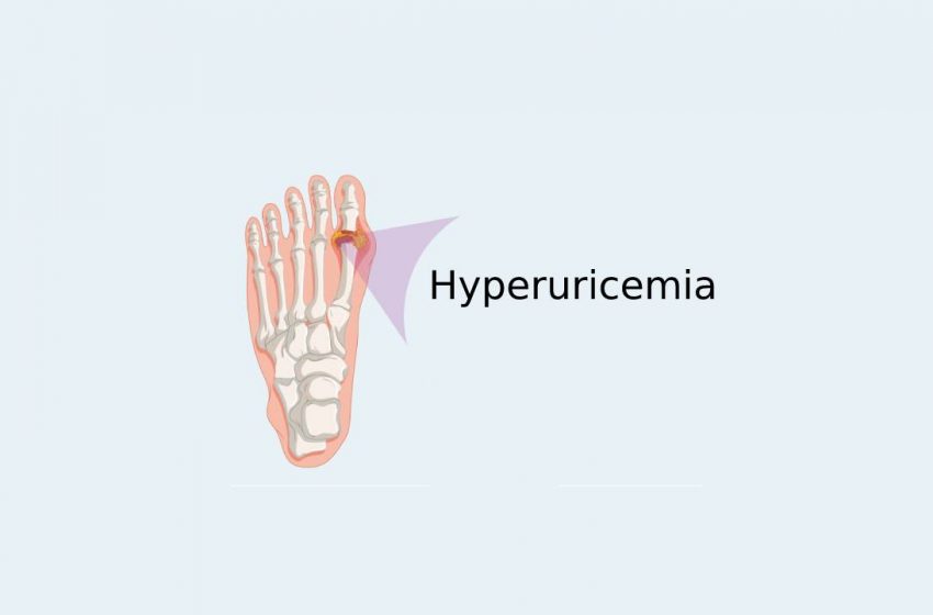  Is CBD Useful in Treating Asymptomatic Hyperuricemia?