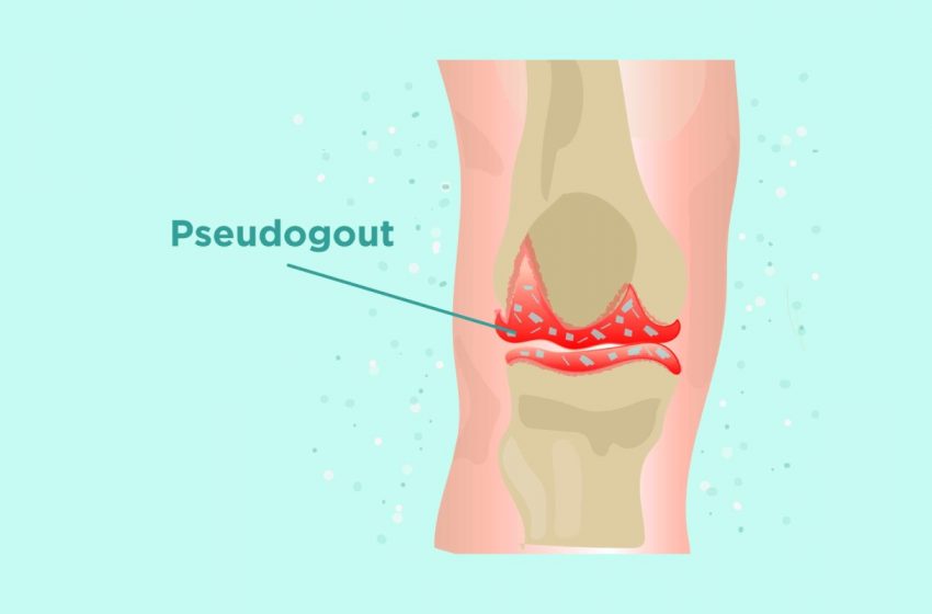  CBD for Pseudogout Relief