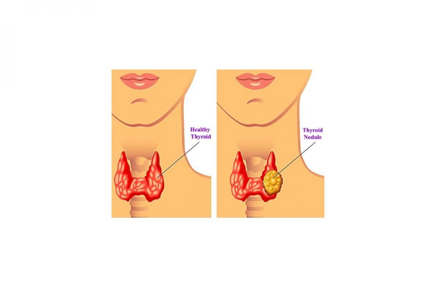  CBD May Help Those Suffering From Hyperthyroidism