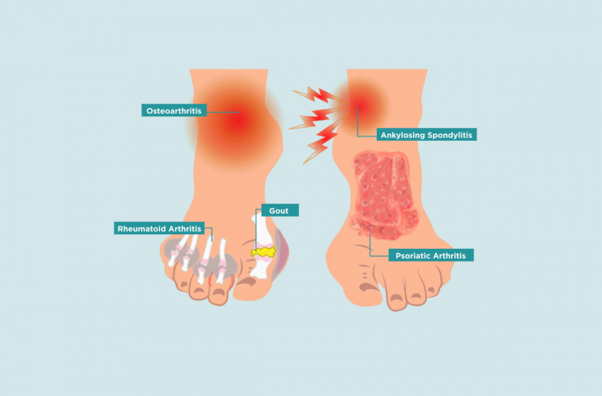  CBD Can Be Used for Several Types of Foot Pain