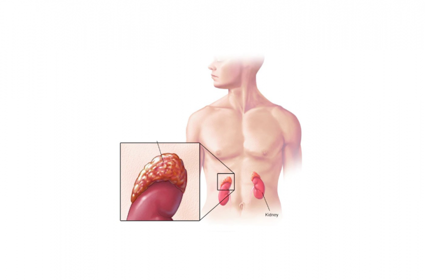  Is CBD Oil Beneficial in Treating Addison’s Disease?