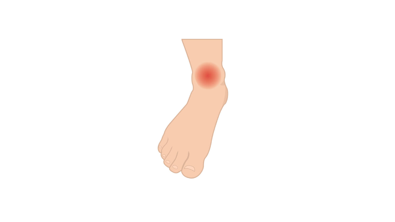  CBD for Arthritis Pain in the Ankles