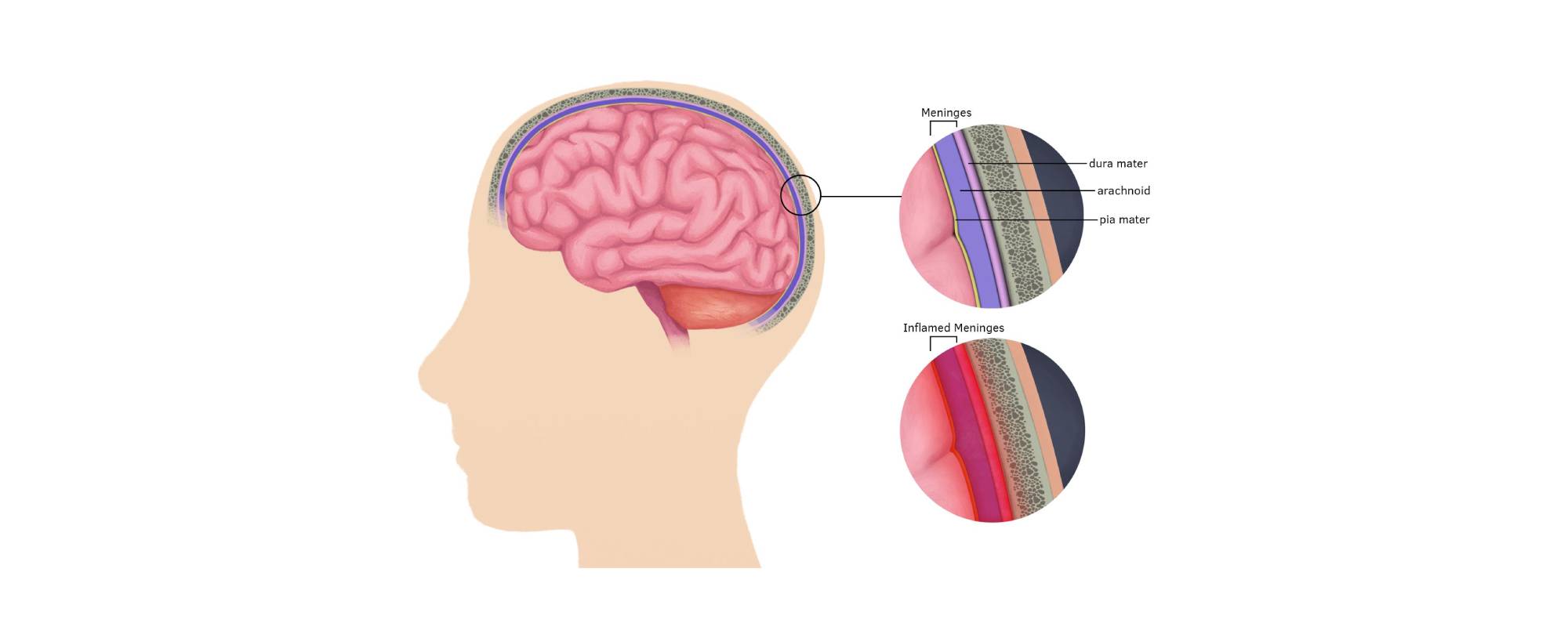 Using CBD in the Treatment of Symptoms of Meningitis (lead image)