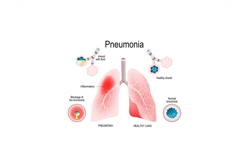  Using CBD for Pneumonia Symptoms