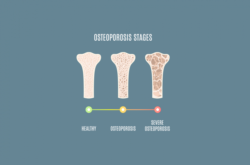  Can CBD Help in Treating Osteoporosis?