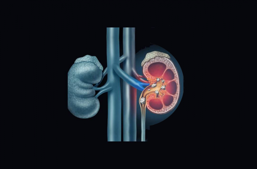  Is CBD Oil an Option for Kidney Stone Pain?