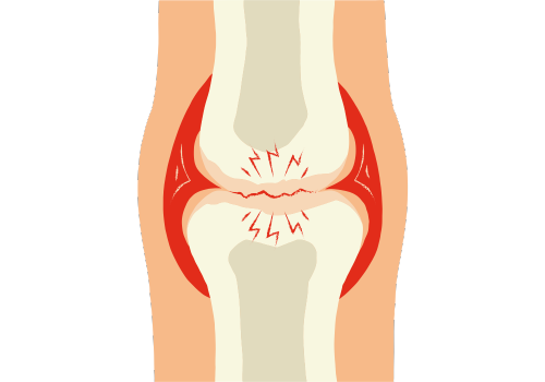 Osteoarthritis Image