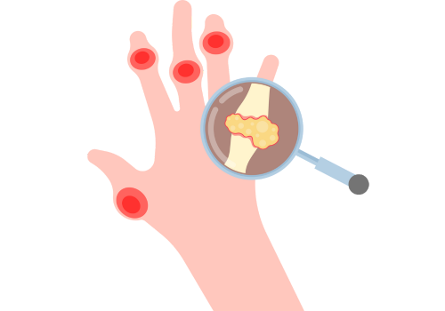 Rheumatoid Arthritis